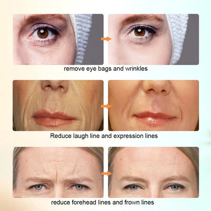 RF Radio Frequency Skin Tightening Device